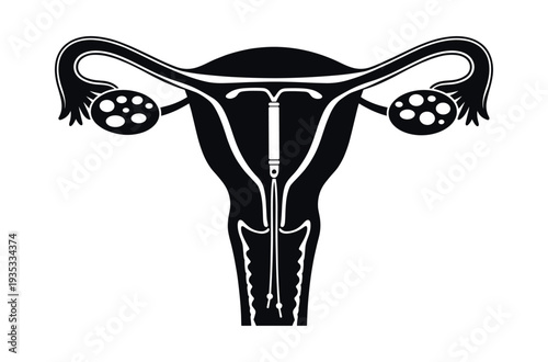 Uterus with ovaries and fallopian tubes, inserting an IUD device for effective long-term family planning and sexual health