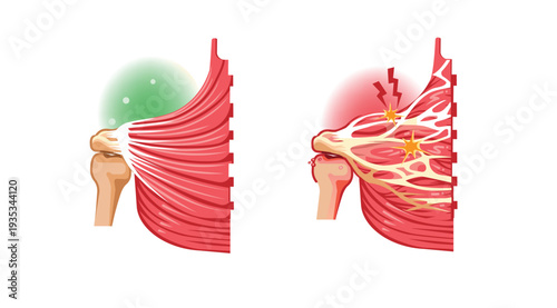 Healthy Muscle vs Fascia Adhesion Comparison
