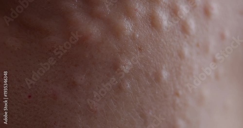 Facial biorevitalization procedure using a hyaluronic acid-based product. Papules on female face after biorevitalization. close-up