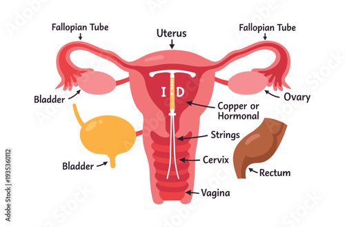 This intrauterine device (IUD) is a form of birth control and contraception that is inserted into the female uterus