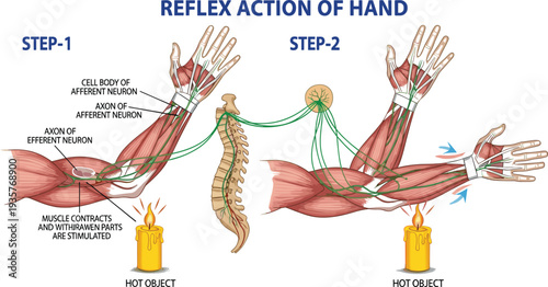 Medical diagram illustrating the human reflex arc showing afferent and efferent neurons responding to a hot object stimulus