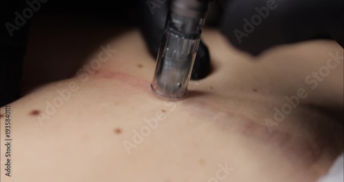 Microneedling procedure for a scar on a human body. Skin restoration in damaged areas.