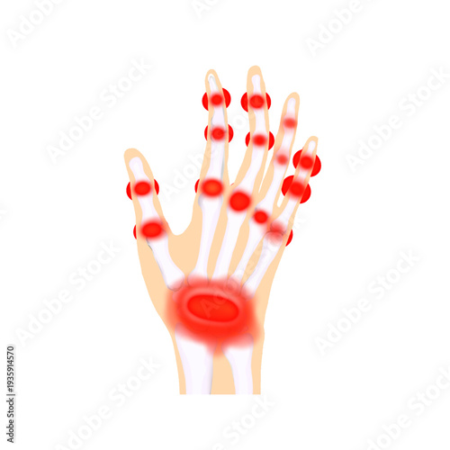 illustration of pain in the joints of the hand bones with red marks