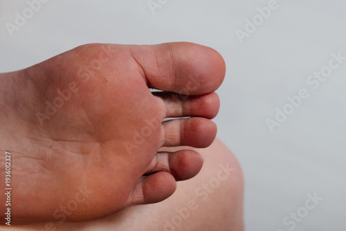 Plantar wart on sole of foot close up