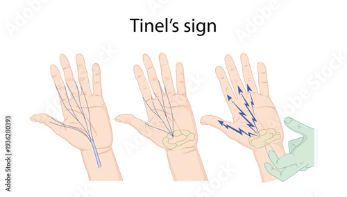 Tinel’s sign
Tinel’s sign is a clinical test used to detect irritated or regenerating nerves by tapping over a nerve, producing tingling or “pins and needles” sensation along its distribution.