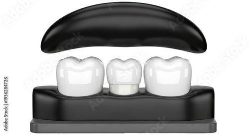 Dental Crown Placement Demonstration