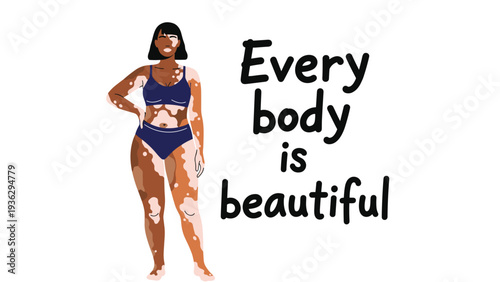 Proud woman with vitiligo skin condition standing in blue underwear next to the message every body is beautiful.