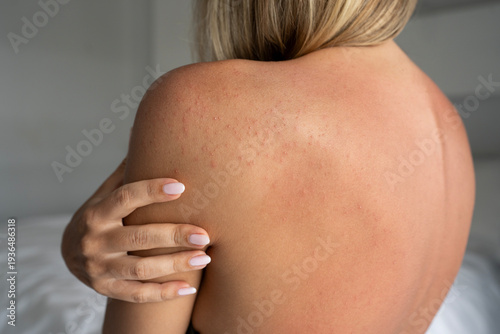 Photos Close-up of female shoulder and back with allergic rash after sun exposure