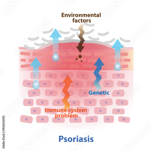 Cross section of Psoriasis on skin layer illustration. Psoriasis plaques are thick, silvery scales. Immune system problem, genetic and environmental factors leads to this condition. Skin care concept.