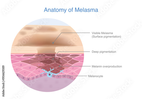 Skin anatomy of Melasma, where excess melanin forms beneath. Dark spots on the surface, causing uneven skin color. Beauty medical diagram.