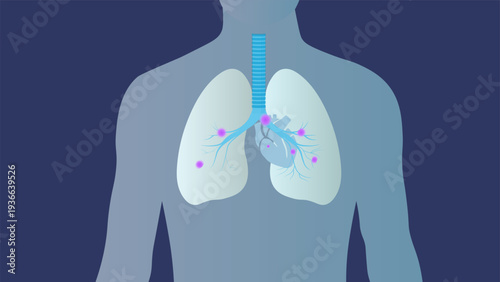 Pulmonary Sarcoidosis with Granulomatous Lung Inflammation Illustration