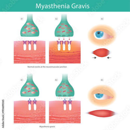 Myasthenia Gravis Neuromuscular Junction Disease Diagram