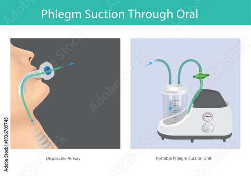 Phlegm Suction Through Oral Medical Illustration