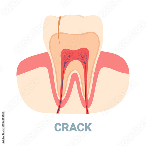 Isolated cracked tooth cross section showing dental nerve and pulp for dental health education vector illustration