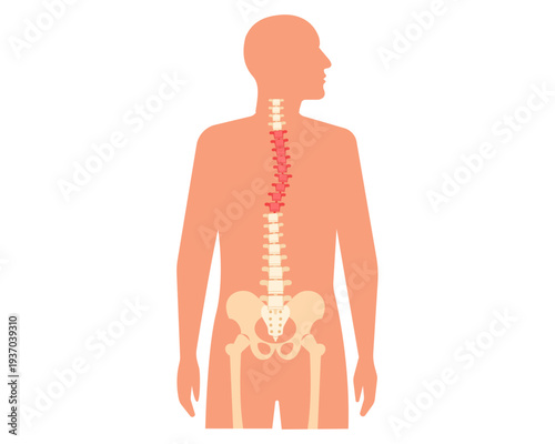 Scoliosis disease curved spine. posture. problems and health
