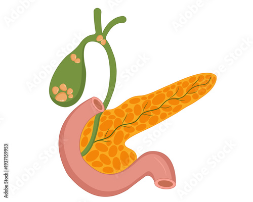 Gallstones in the human body stones in the gallbladder vector illustration