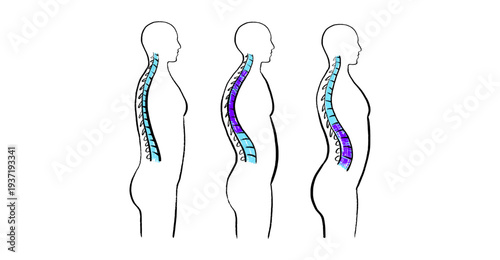 Scoliosis spine deformity