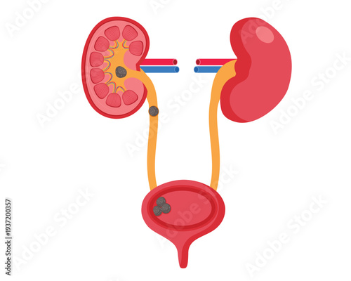 Urologist medical disease cross section of ureter with stone vector illustration
