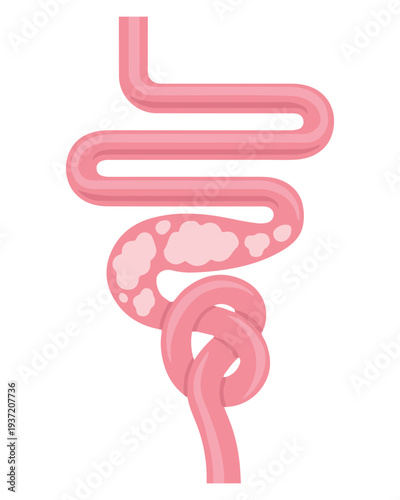 Intestinal Disorder Anatomy