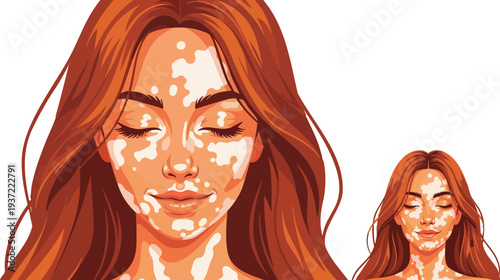 Vector illustration of woman with vitiligo