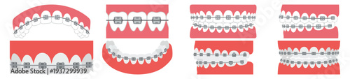 BRACES - Set of teeth with silver brackets and wire  Flat Vector Illustration on Transparent Background