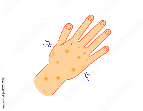 Monkeypox, measles, or chickenpox concept. Allergy symptoms. Rashes, bumps, or pustules. Skin health problems. Illustration of a hand with bumps. Flat style illustration with outline. White background