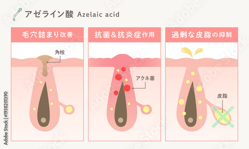 アゼライン酸の美容効果｜毛穴詰まり改善・抗菌抗炎症・皮脂抑制のスキンケア成分図解