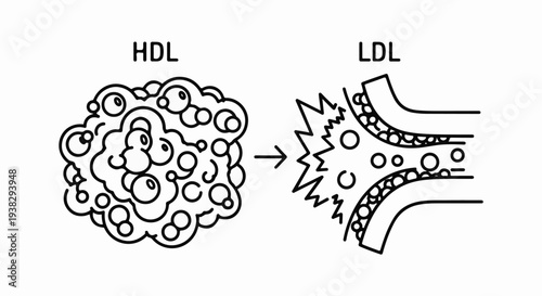 Diagram showing HDL transforming into LDL and obstructing a blood vessel