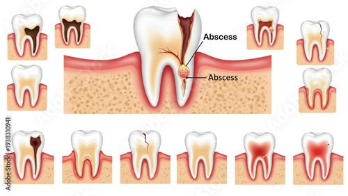 Dental anatomy vector illustration showing tooth decay stages, infection damage, abscess formation, and oral healthcare diagram for education and treatment understanding.