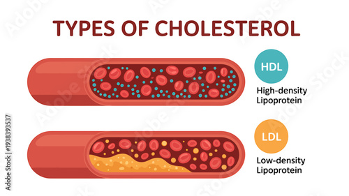 Infographic about types of cholesterol HDL and LDL in blood vessels