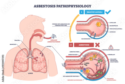 Asbestosis pathophysiology, inhaled asbestos fibers trigger macrophage injury and collagen scarring in alveoli, impairing gas exchange, key objects, lungs, alveoli, fibers, transparent background.