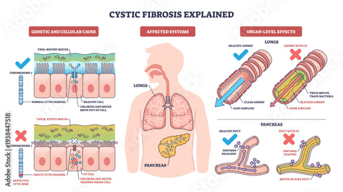 Cystic fibrosis explained, visual summary of CFTR mutation causing thick mucus in lungs and pancreas, contrasting clear and blocked airways to show disease effects, transparent background.