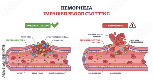 Hemophilia impaired clotting concept compares normal vs deficient repair in a blood vessel, highlighting platelets, red blood cells, and missing clotting factors causing bleeding.