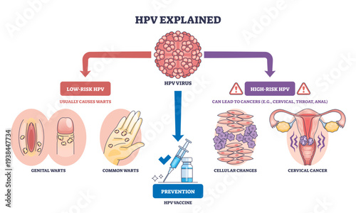 HPV explained overview illustrates virus types, vaccine syringe, and cervix, showing how low-risk cause warts and high-risk lead to cancer, with prevention guidance, transparent background.