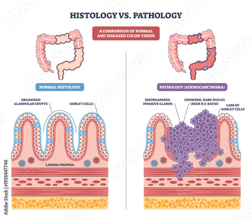 Histology vs Pathology shows colon tissue comparison, normal crypts with goblet cells versus adenocarcinoma tumor mass, transparent background. Main objects, colon, crypts, tumor cells.