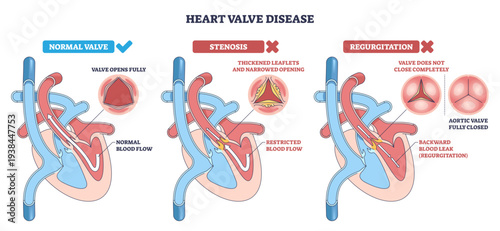 Heart valve disease diagram compares normal, stenosis, and regurgitation, shows heart, aortic valve, and blood flow arrows to explain function and defects, transparent background.
