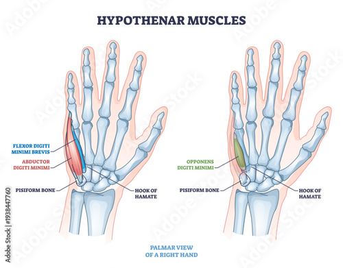 Hypothenar muscles outline shows palm anatomy and little finger control, highlighting abductor digiti minimi, flexor digiti minimi brevis, and opponens digiti minimi, transparent background.