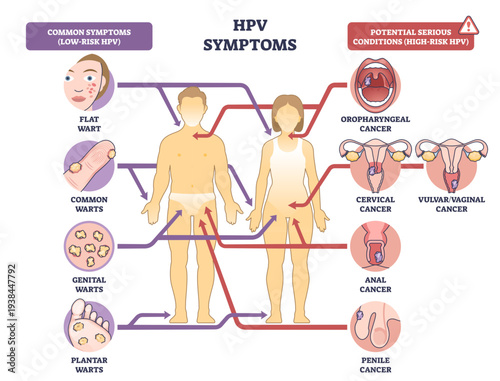 HPV symptoms diagram shows male and female silhouettes with arrows linking warts and cancer sites, key objects, human bodies, wart icons, reproductive organs, transparent background.