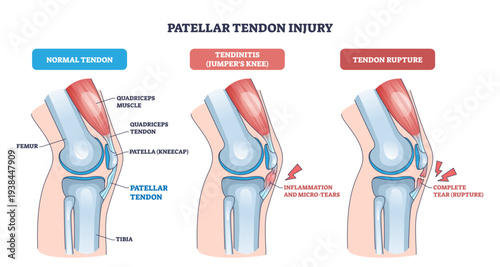 Patellar tendon injury visualizes normal, tendinitis, and rupture, focusing on patella, patellar tendon, and quadriceps to convey knee pain progression, transparent background.