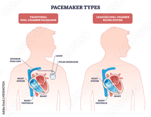 Pacemaker types overview compares traditional dual-chamber and leadless devices, highlighting heart, leads, and pulse generator placements, transparent background.