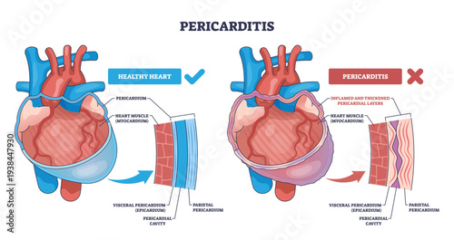 Pericarditis comparison shows healthy vs inflamed heart, highlighting pericardium layers, myocardium, and pericardial cavity, clear labels explain differences, transparent background.