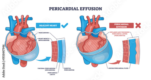 Pericardial effusion outline illustrates fluid buildup compressing the heart, contrasting normal and inflamed pericardium, key objects, heart, pericardial layers, excess fluid, transparent background.