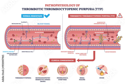 TTP pathophysiology illustrated, ADAMTS13 deficiency leads to ultra-large vWF, platelet-rich microthrombi in a blood vessel, key items are platelets, RBCs, microthrombus, transparent background.