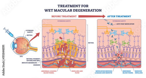 Wet macular degeneration treatment, retina cross-section shows before-after anti-VEGF effect, key objects, syringe, retina, leaking vessels, transparent background.