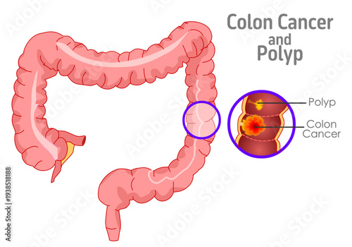 Larger colon polyps are at greater risk of turning cancerous. Large intestine cancer, anatomy, diagram. Illustration vector