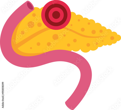 Pancreas organ illustrating tumor, representing disease and oncology concept