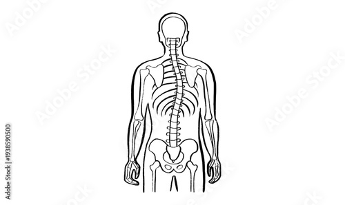 Scoliosis spine deformity