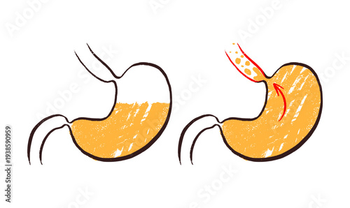 Gastroesophageal reflux pain