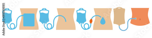 PERITONEAL DIALYSIS - Soft pouch with a tube and abdominal outline  Flat Vector Illustration on Transparent Background