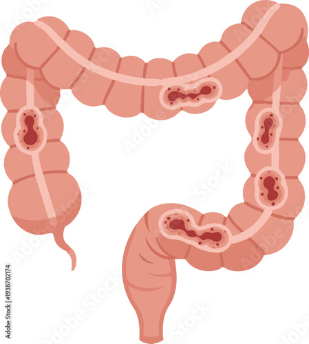 Medical illustration of the large intestine showing multiple inflamed diverticula pouches along the colon wall, representing diverticulitis, abdominal pain, and digestive tract disease.
